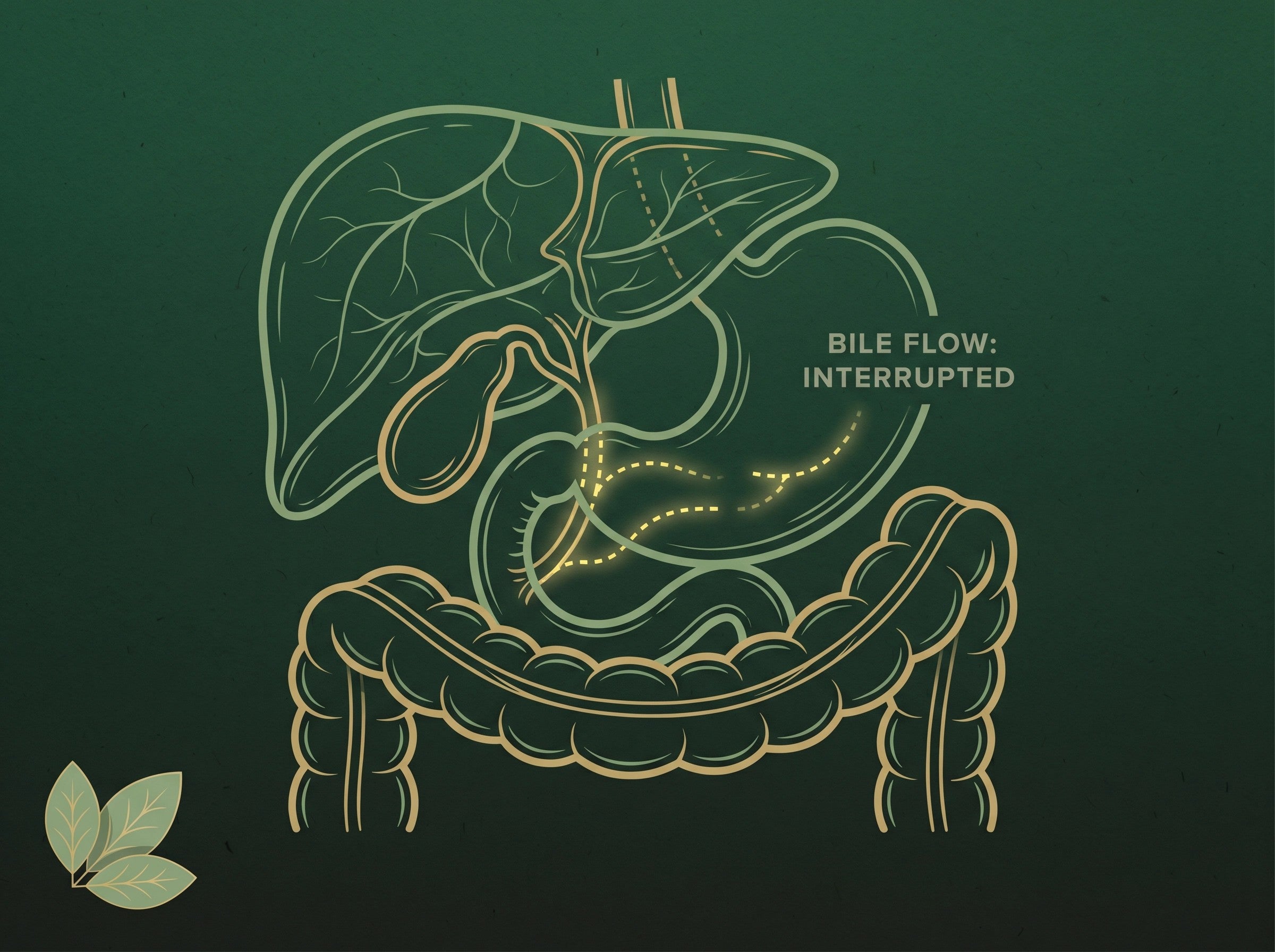 The bile drought mechanism behind GLP-1 constipation